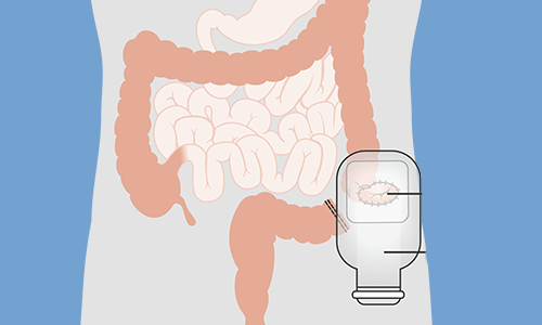 OSTOMIAS